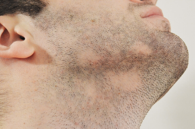 alopecia areata de la barba previo injerto