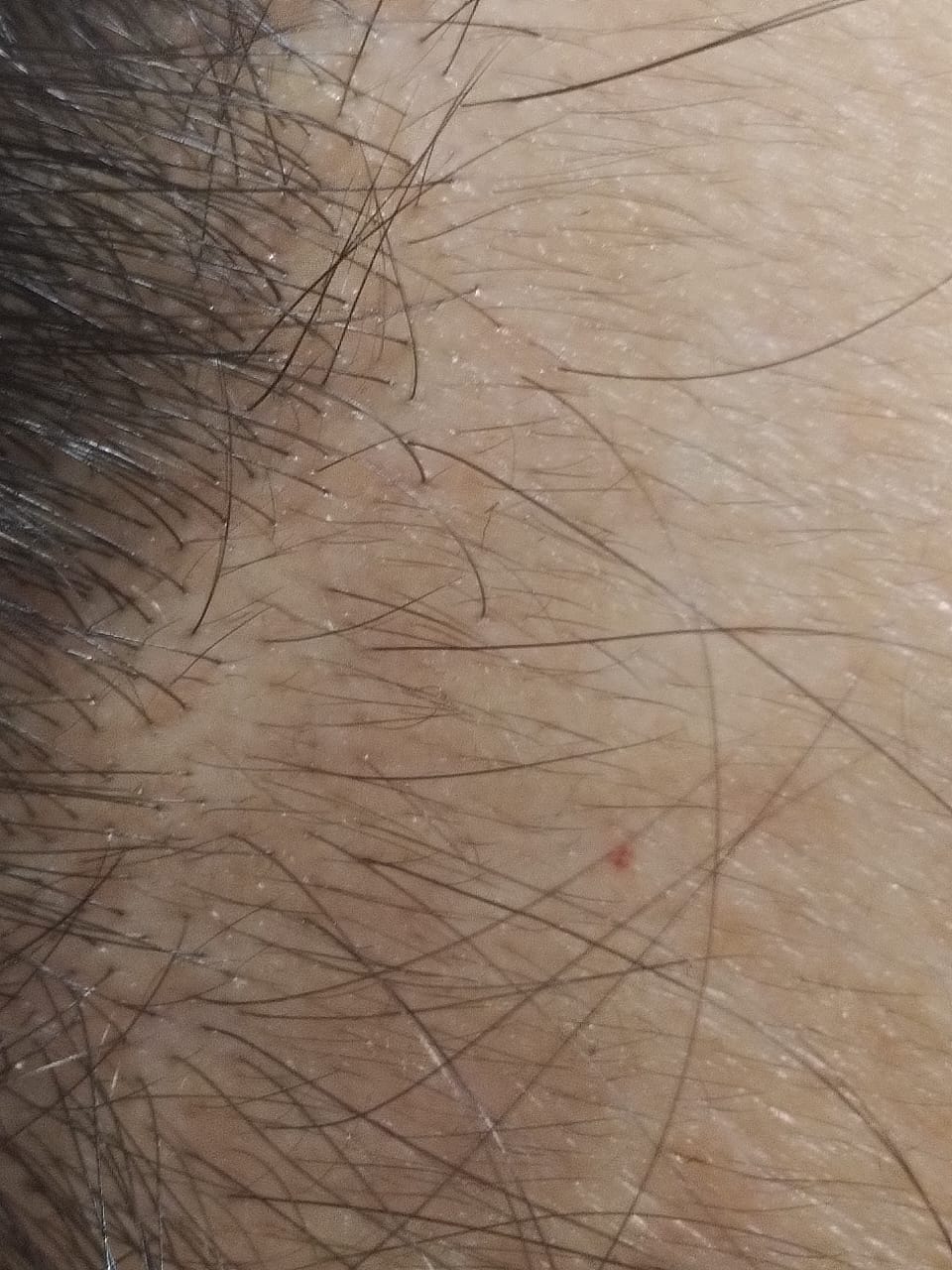 foto alopecia despues tratamiento mesoterapia microagujas