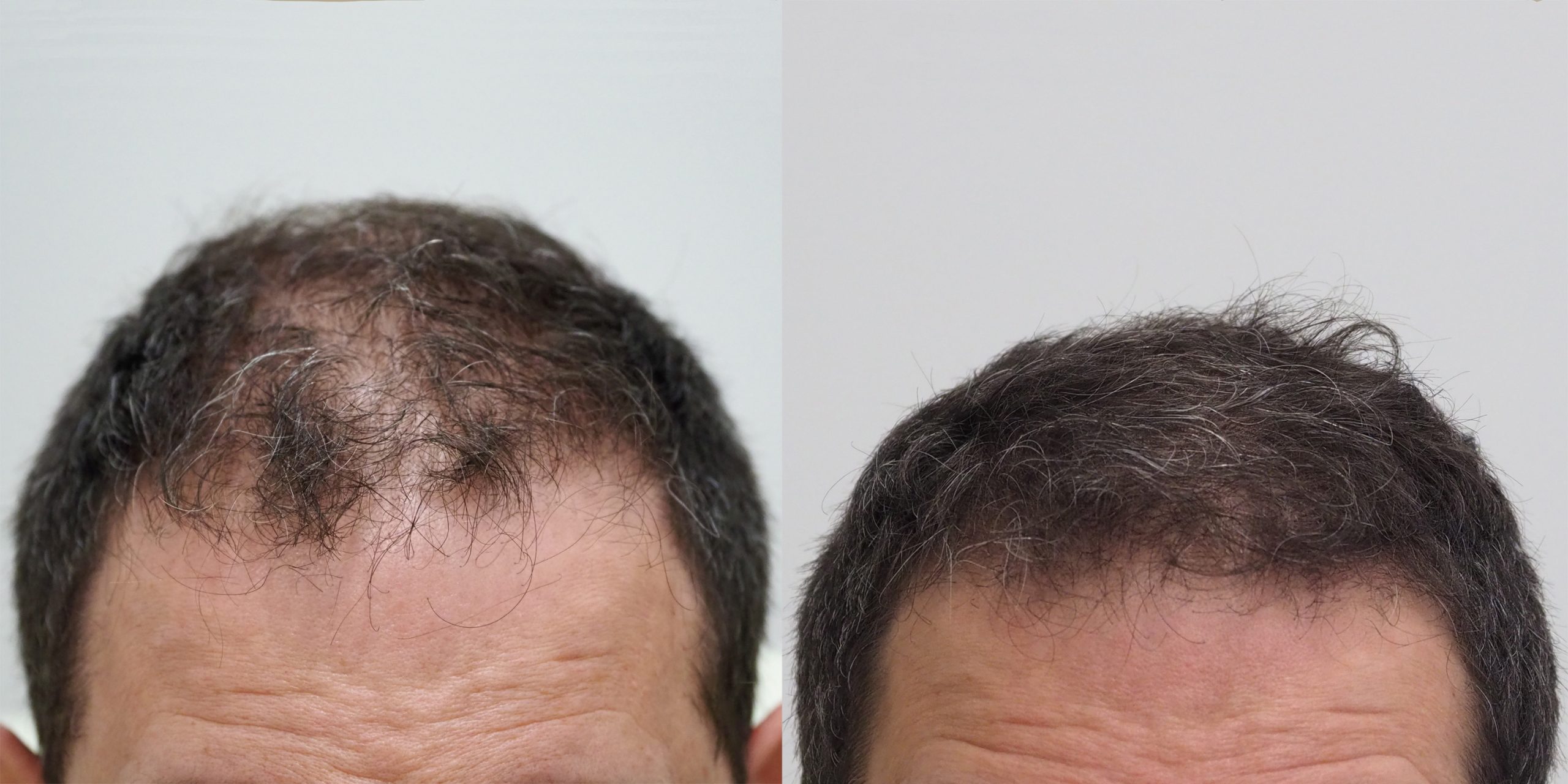 alopecia androgenetica tratamiento toluca