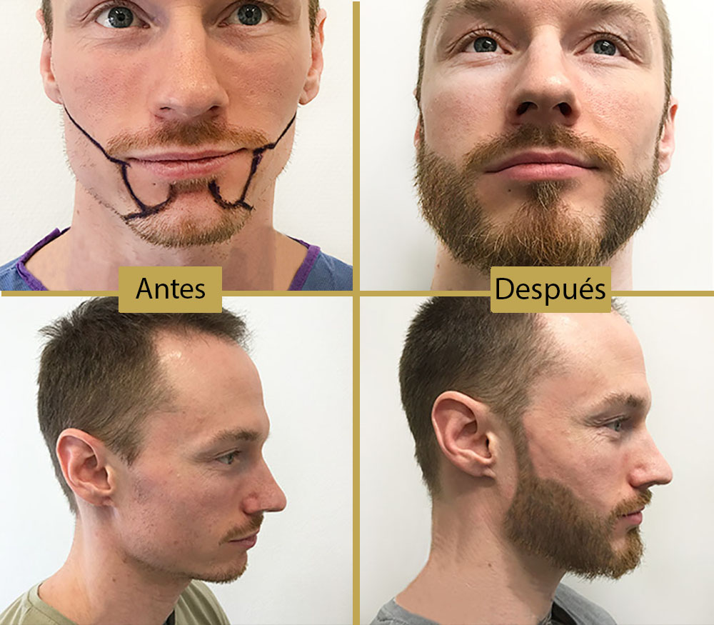 trasplante completo de barba y bigote en paciente clinica de alopecia toluca