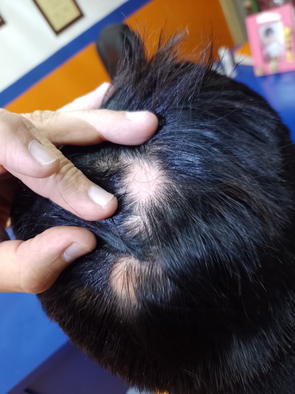 alopecia areata masculino clinica franco toluca