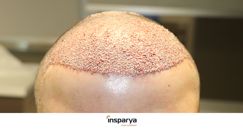 costras despues del injerto capilar en alopecia androgenetica