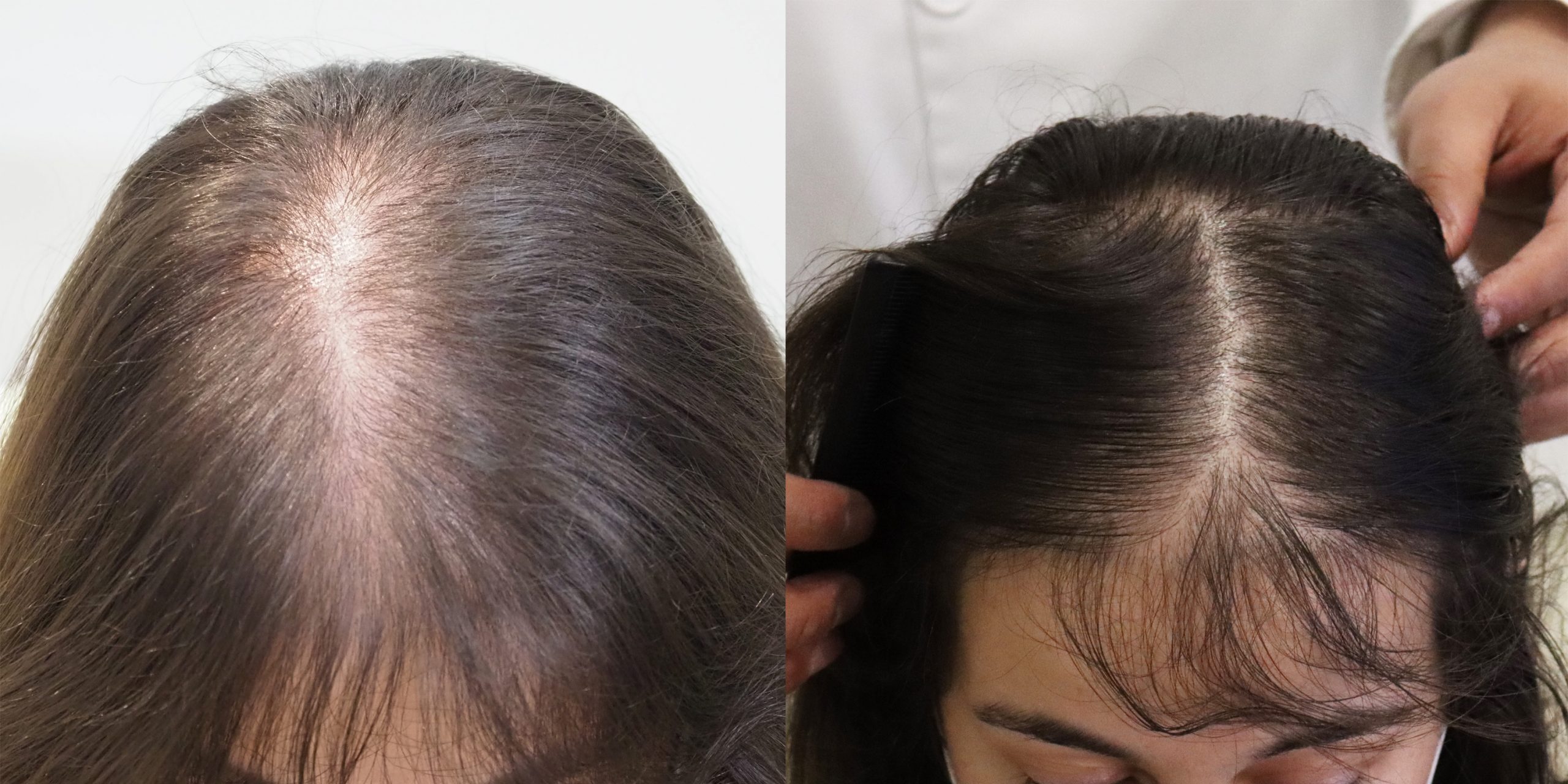 alopecia difusa tratamiento mujeres toluca