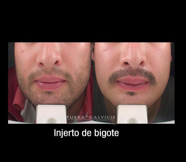 aumento de bigote clinica alopecia toluca