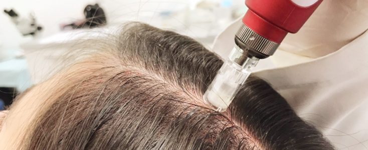 mesoterapia tratamiento alopecia clinica franco toluca