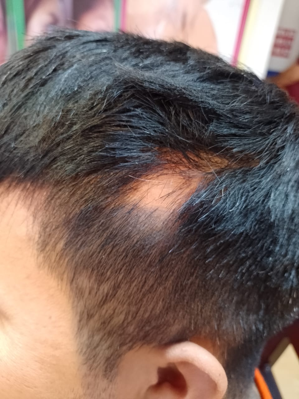 estimuladores de foliculo con mesoterapia para alopecia