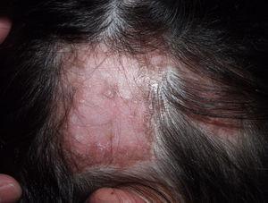 alopecia cicatrizal en tratamiento clinica franco toluca