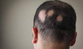 alopecia areata en masculino clinica de alopecia toluca