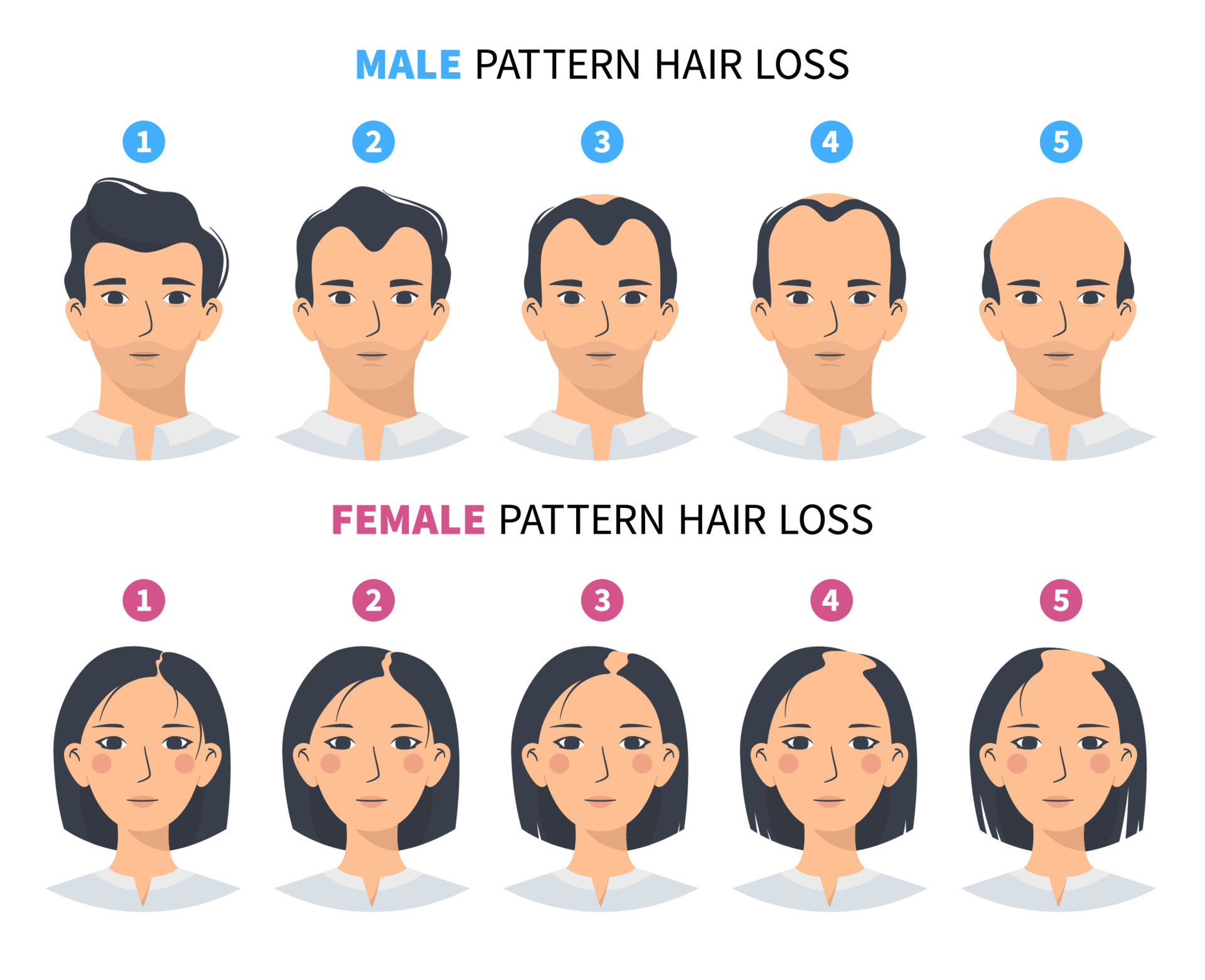 alopecia androgenetica patrones comunes hombres y mujeres