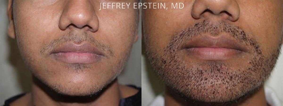 antes y despues trasplante barba clinica franco