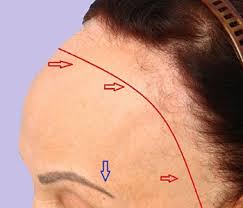 alopecia fibrosante clinica franco toluca