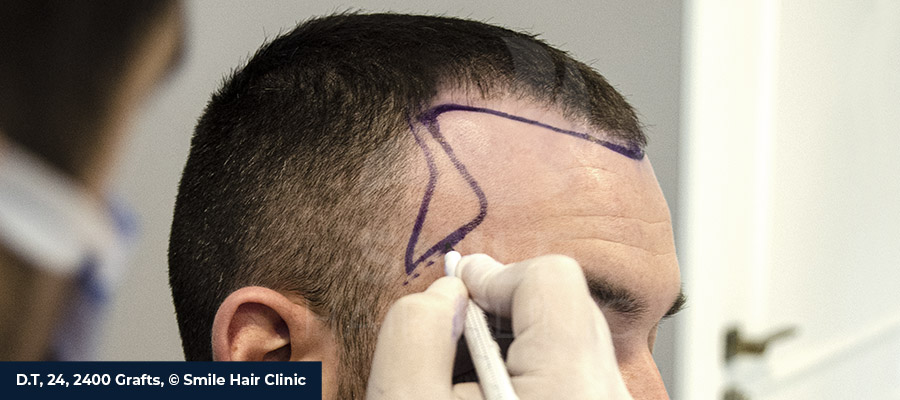 marcaje restauracion injerto patillas y frente clinica alopecia toluca
