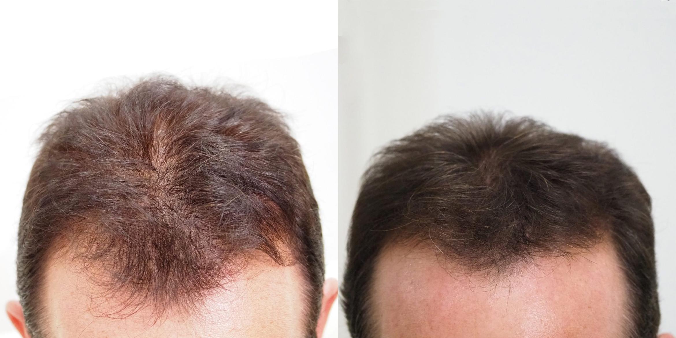 injerto de cabello frontal en paciente clinica de alopecia toluca