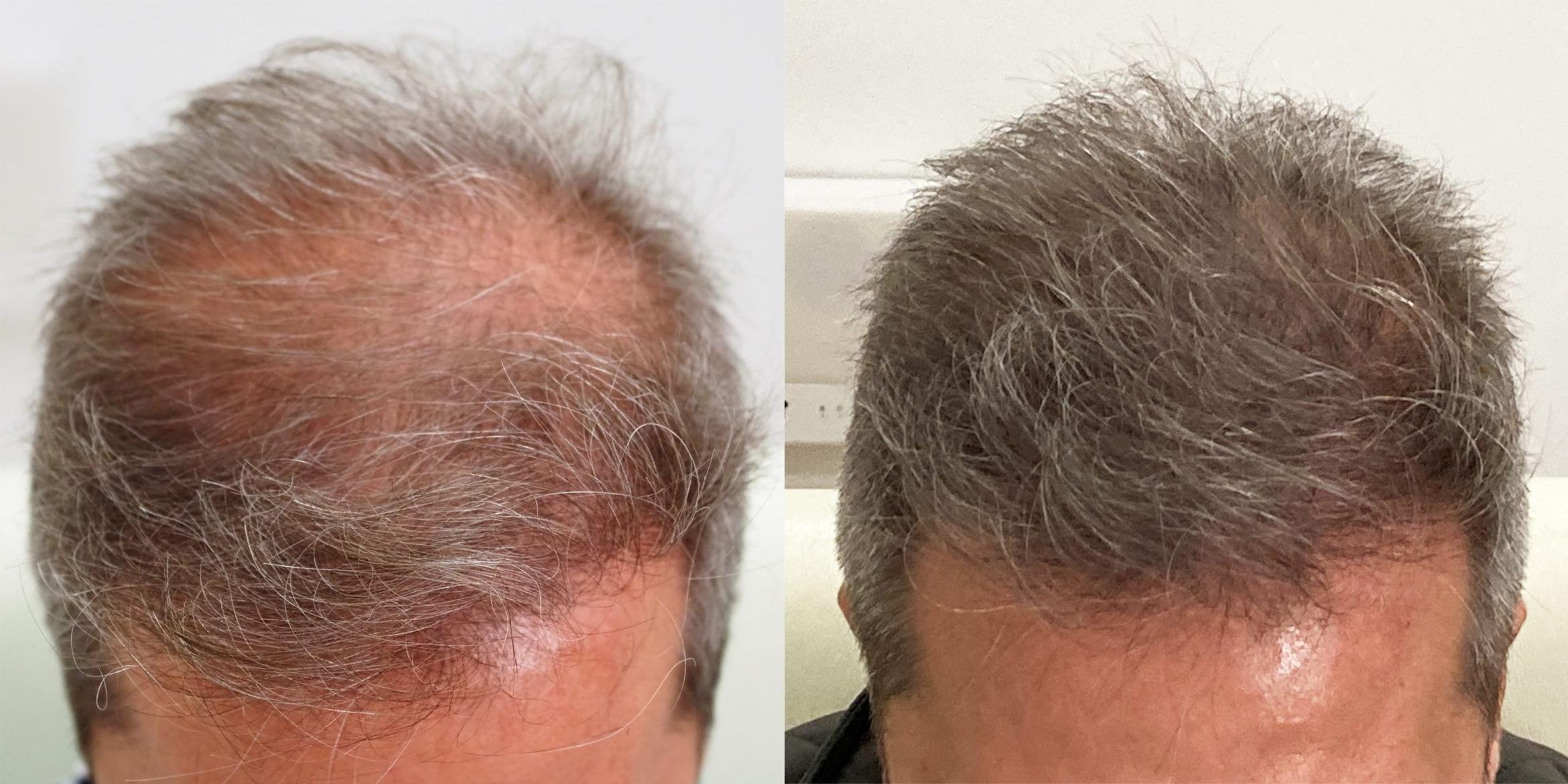 Trasplante de cabello clinica de alopecia toluca